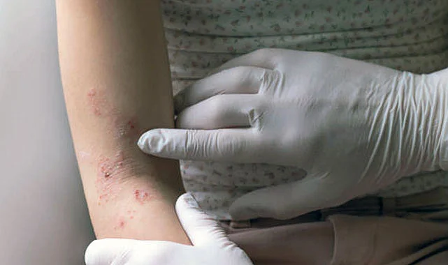 14 Eylül Dünya Atopik Egzema Günü hakkında bilgi! Atopik dermatit nedir?