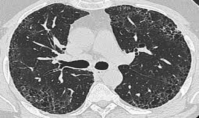 İdiyopatik Pulmoner Fibrozis tanı ve tedavisi! İdiyopatik Pulmoner Fibrozis nedir?