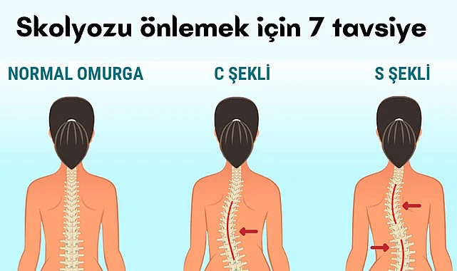 Skolyoz belirtileri, Skolyozu önlemek için 7 tavsiye